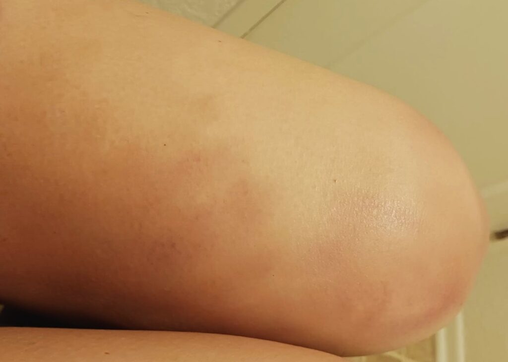 Bruised thigh from Grade 2 injury healed by quad strain exercises