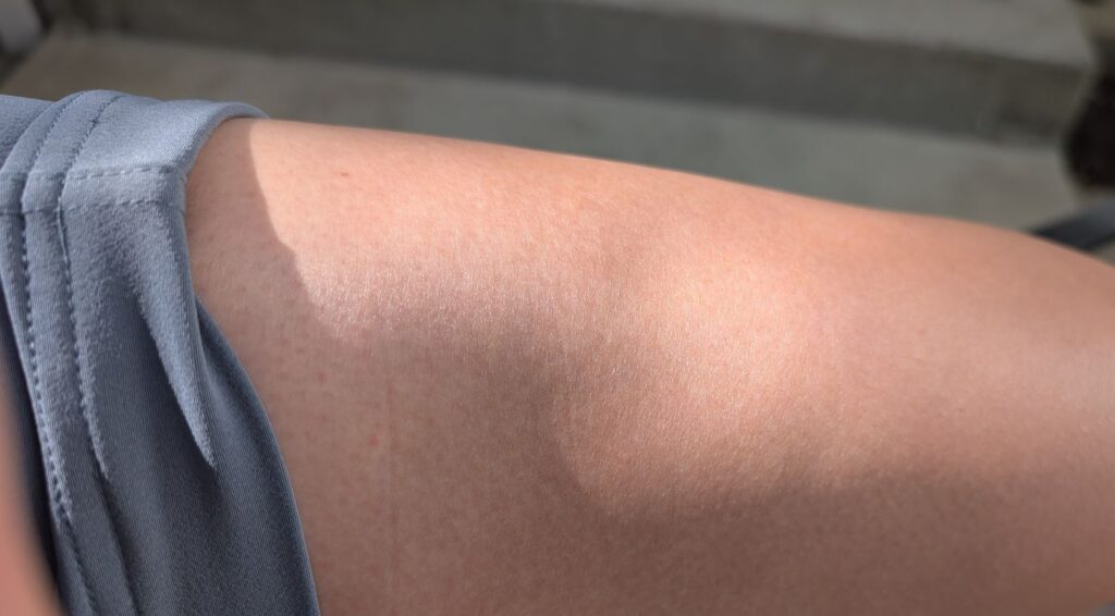 Close-up of thigh muscle tear healed by quad strain exercises