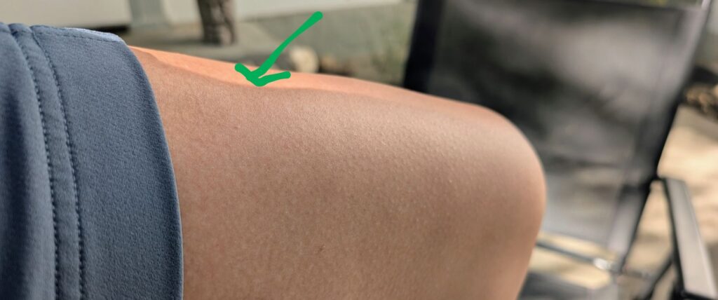 Permanent dent in thigh muscle from grade 2 injury healed by quad strain exercises